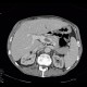 Trombosis of portal vein: CT - Computed tomography